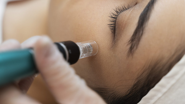 SkinPen Full Face $229